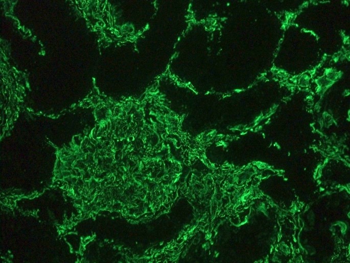 Figure 2. Indirect immunofluorescence staining of human kidney tissue section with MUB1903P (diluted 1:1000), showing the specific pattern of vimentin in the mesenchymal cell types, such as fibroblasts in the connective tissue, podocytes, and endothelial cells in blood vessels. As expected, no reactivity is seen in the epithelial cell compartment
